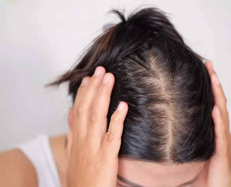 pictures-of-telogen-effluvium-2